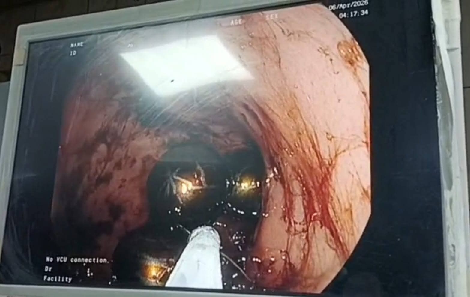 جامعة المنصورة: إنقاذ رضيع من ابتلاع 6 قطع مغناطيس دون جراحة بمستشفى الأطفال