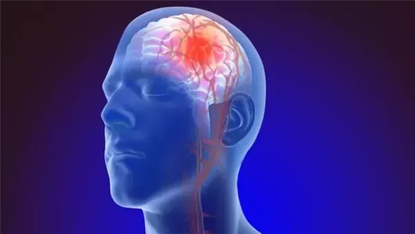 أعراض جلطة المخ: انتبه لهذه العلامات لتحمي نفسك