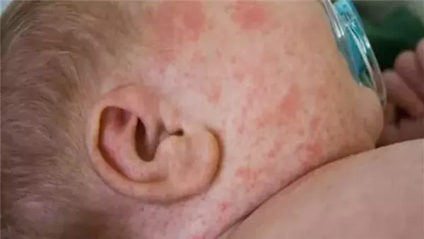 نصائح لحماية الأطفال من حمو النيل في موجات الحرارة المرتفعة