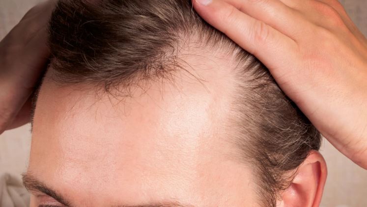 اكتشاف علامات الصلع الوراثي مبكرًا: نصائح من خبير الأمراض الجلدية