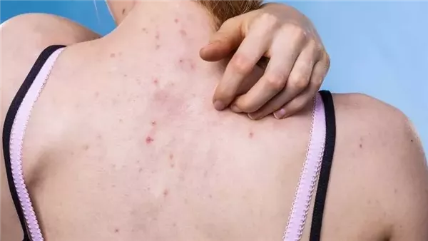 أسباب ظهور حب الشباب في الظهر وكيفية التعامل معه