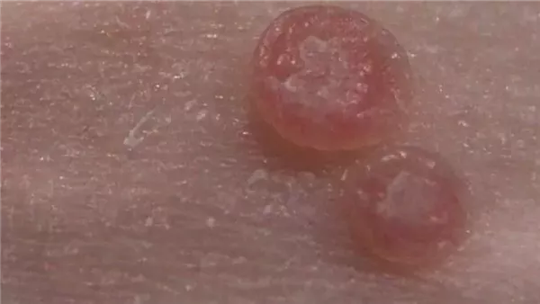 تعرف على عدوى الخميرة: الأعراض، الأسباب وسبل العلاج