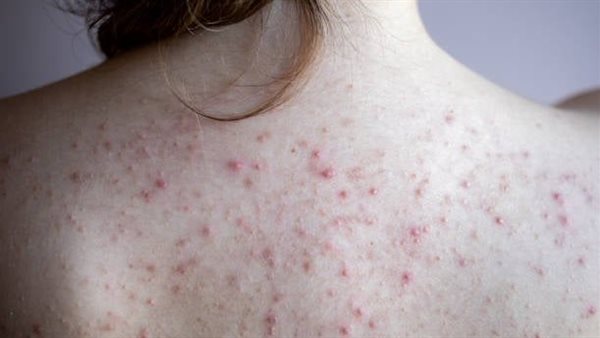 اكتشفي طريقة صنع صابونة طبيعية لعلاج حبوب الظهر